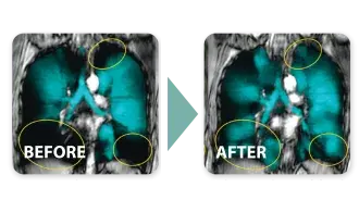 Aerobika* Ventilation Lung Images
