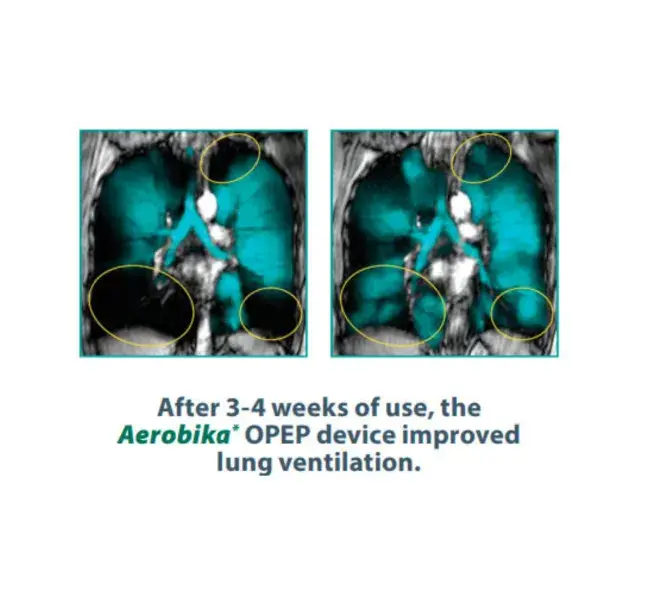 diagram showing change in lung function after 3-4 weeks of aerobika opep device use