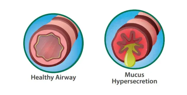healthy airway image