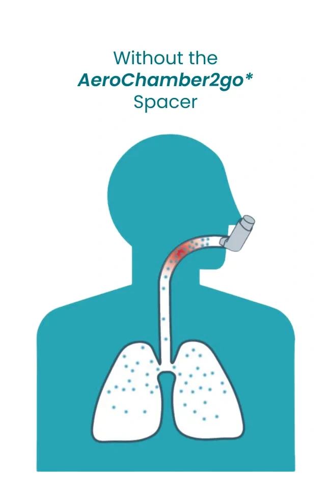 Without the AeroChamber2go* Spacer