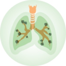 Living with Bronchiectasis