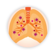 Living with NTM Lung Disease